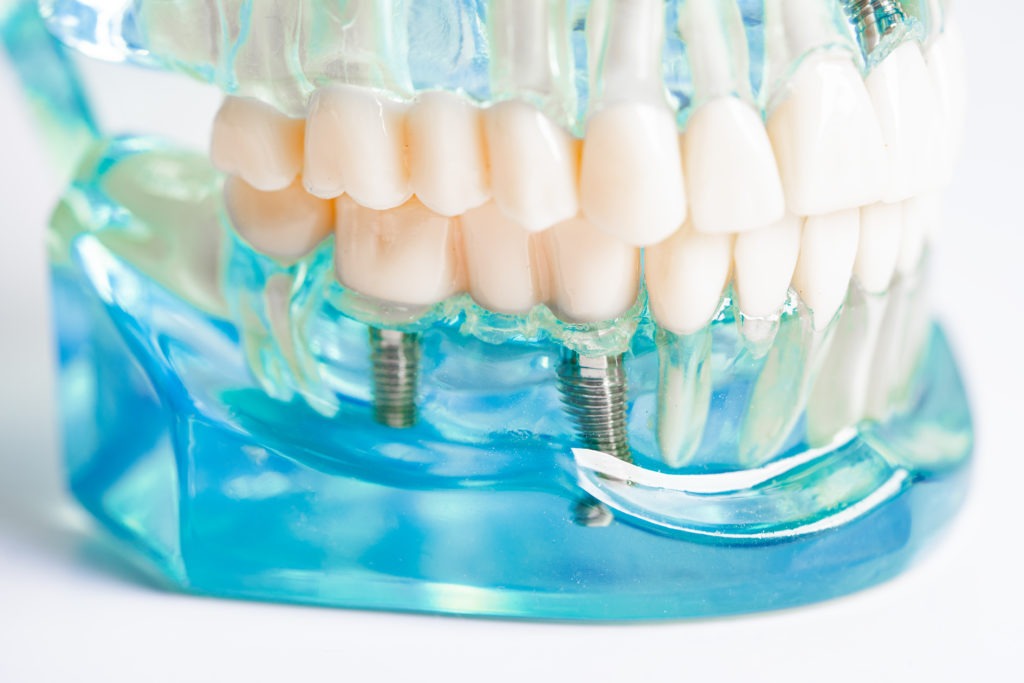 Dental Implant Care